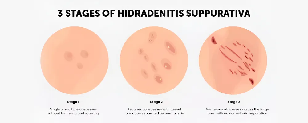 Hidradenitis Suppurativa