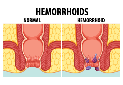 hemorrhoids
