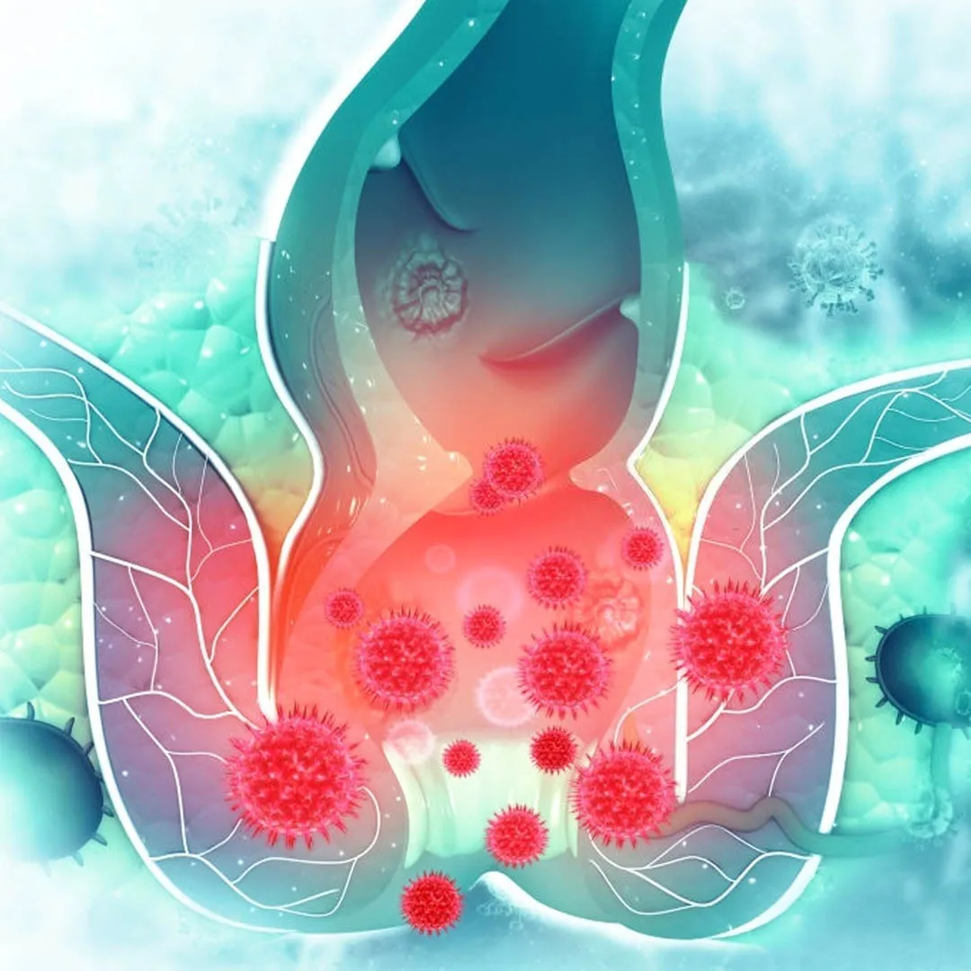 hemoroid-basur-nedir