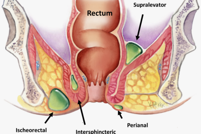 Does Perianal Abscess Recur?