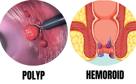 What Are the Differences Between Anal Polyps and Hemorrhoids?