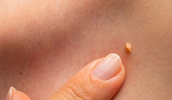 درمان زگیل تناسلی