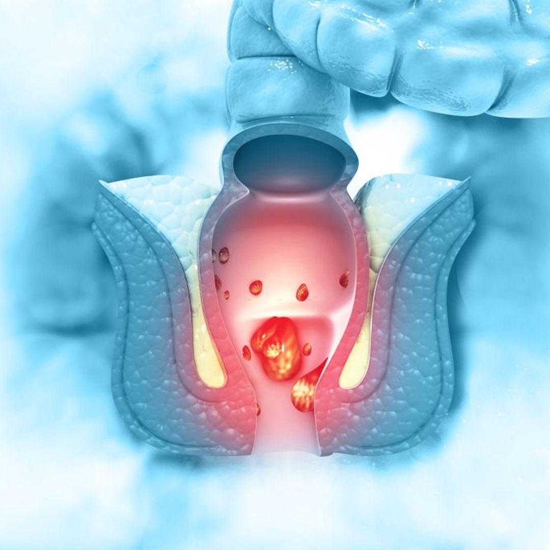 علائم فیستول مقعدی