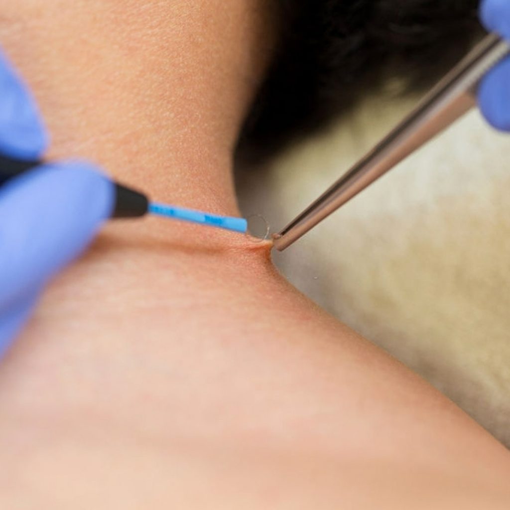 راه های پیشگیری از زگیل تناسلی HPV