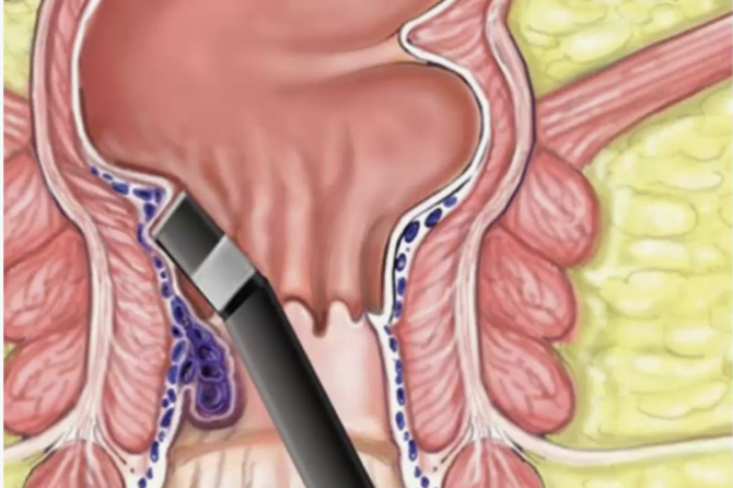 کوآگولاسیون با اشعه مادون قرمز چیست؟