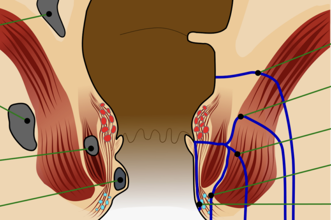 عمل جراحی بواسیر چقدر طول می‌کشد؟
