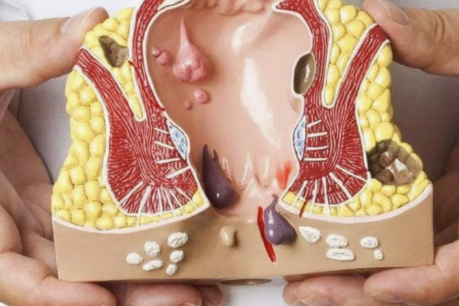 آیا جراحی فیستول مقعد خطرناک است؟