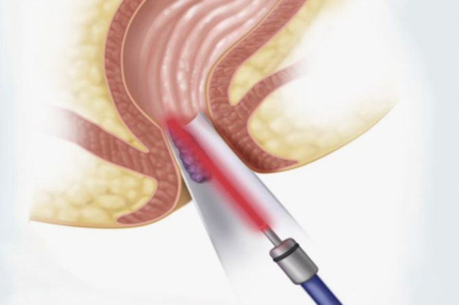 هموروئیدکتومی چیست؟