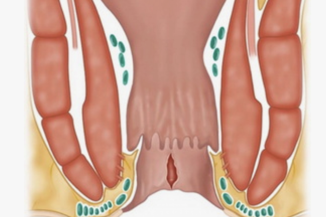 تورم در مقعد نشاندهنده چه بیماریهایی است؟