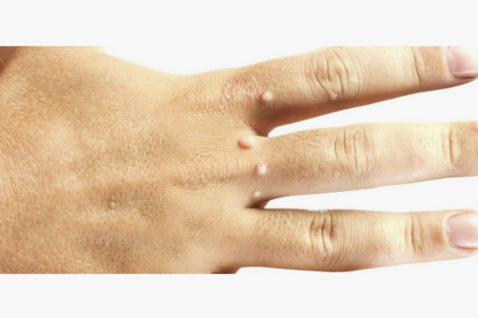 هزینه درمان زگیل در ترکیه چقدر است؟