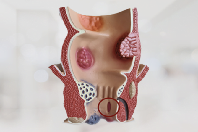 چگونه میتوان شقاق مقعدی را درمان کرد؟