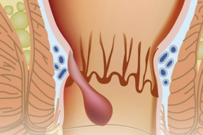 درجات بواسیر چیست؟