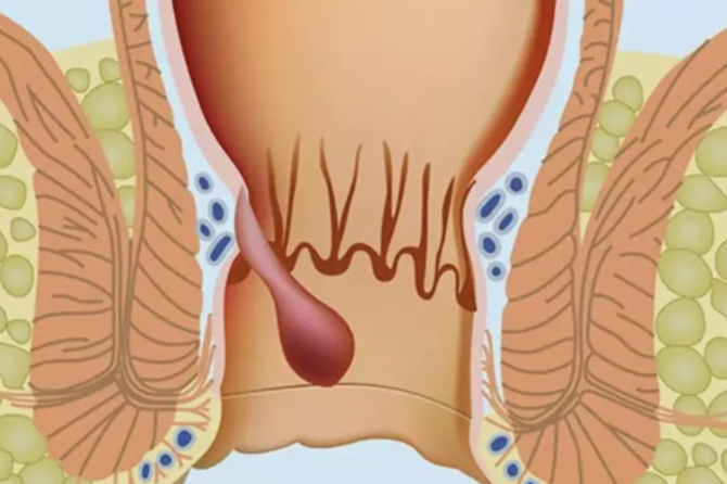 در صورت خونریزی بواسیر و درد شدید چه باید کرد؟