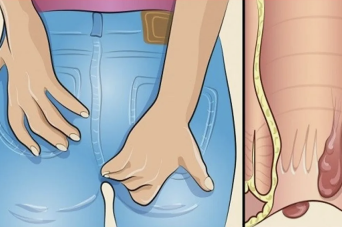 اگر تورم مقعد از بین نرود چه باید کرد؟