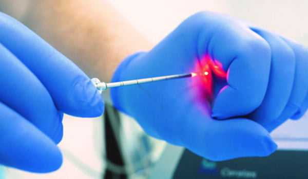 Traitement non chirurgical des hémorroïdes