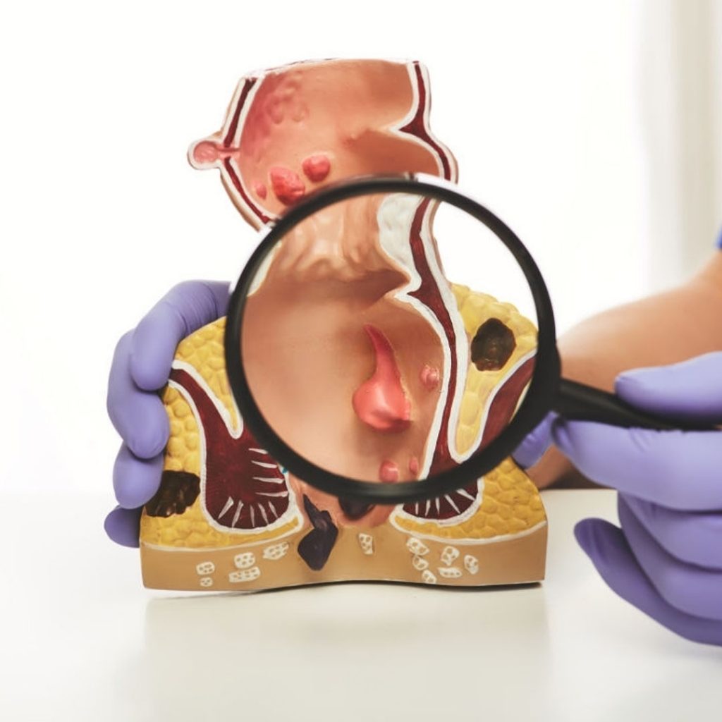 Qu'est-ce qu'une fissure anale ?
