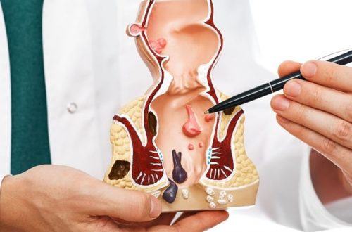 Qu'est-ce qu'une fistule anal ?