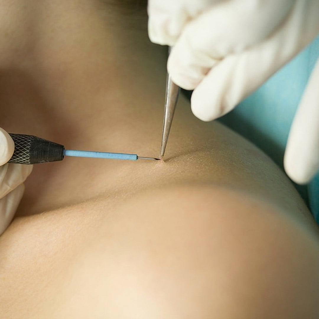 Quels sont les symptômes des verrues génitales ?