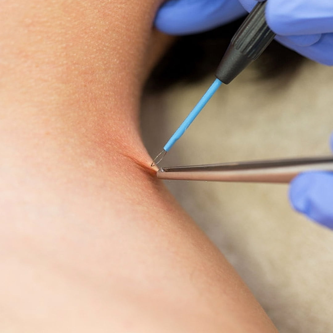 Qu'est-ce que la verrue génitale (HPV) ?