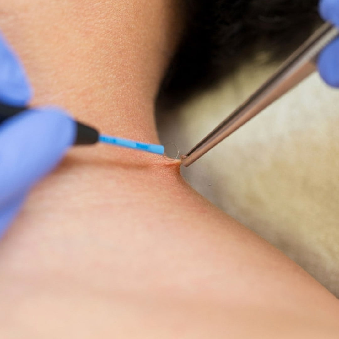 Comment se transmet une verrue génitale (condylome) ?