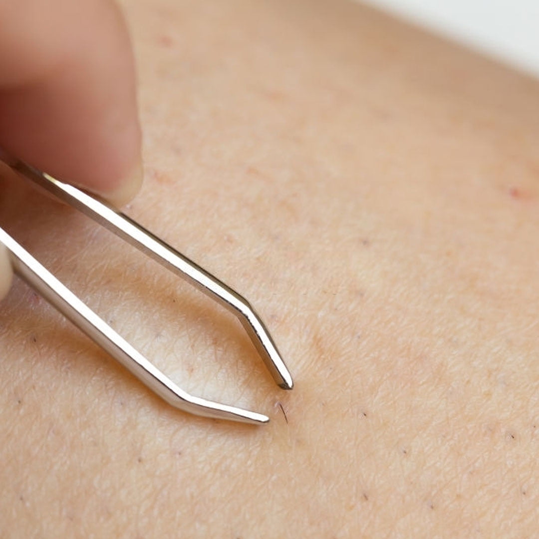 Quels sont les symptômes du Kyste pilonidal ?