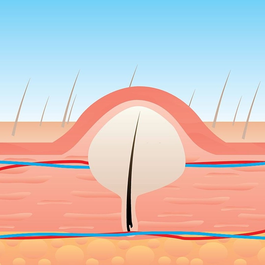 Traitement du kyste pilonidal