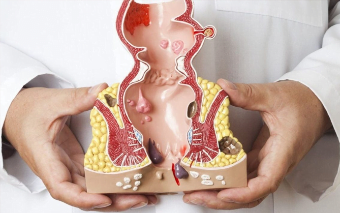 Traitement non chirurgical des hémorroïdes
