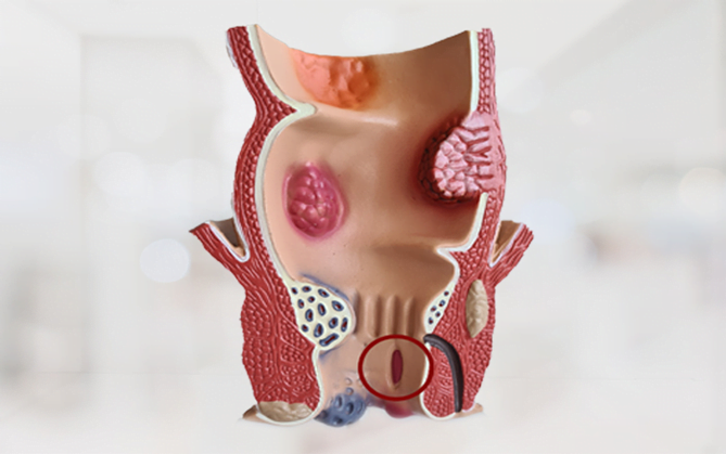 Traitement de la fissure anal non chirurgical