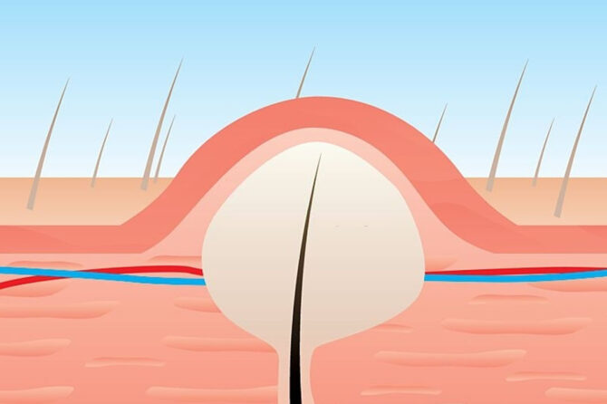 Comment la chirurgie du un Kyste pilonidal est-elle pratiquée ?