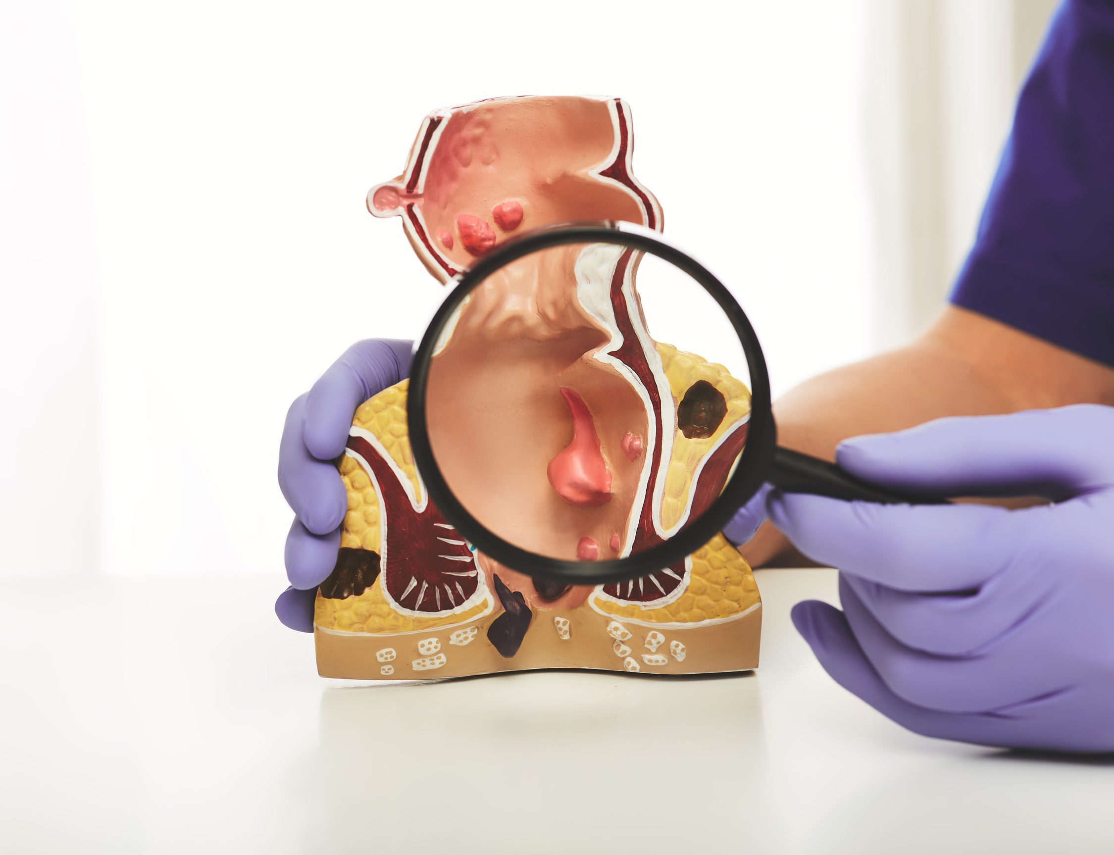 fistule anale