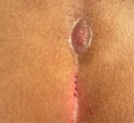 Avant le traitement du Kyste pilonidal (sinus pilonidal)