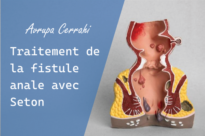 Traitement de la fistule anale avec Seton