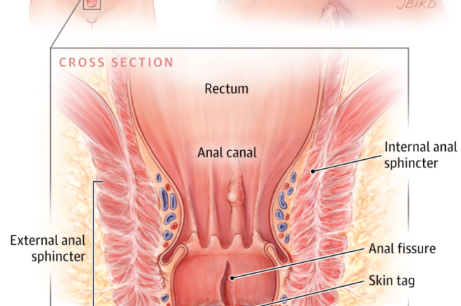 Que faire pour les fissures anales?