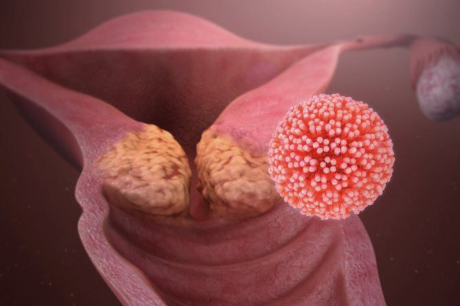 Qu’est-ce que le condylome ?