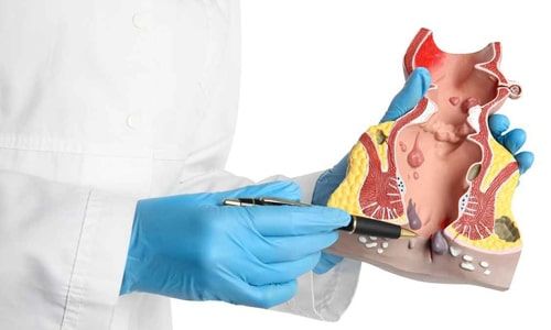 Qu’est-ce que la fistulectomie ?