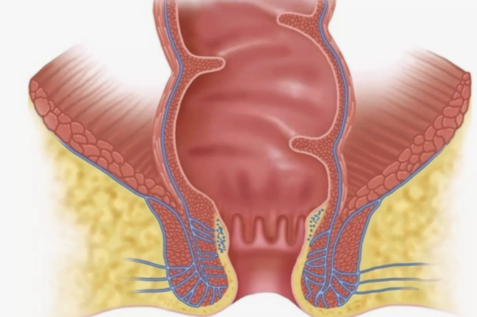 Quels Maladies sont Indiquées par le Saignement Rectal?
