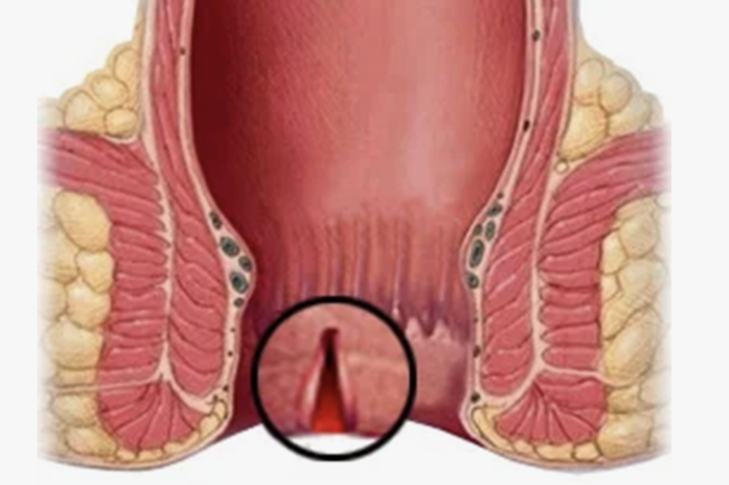 Comment se fait le traitement non chirurgical de la fissure anale ?