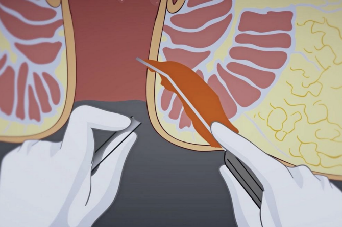 Comment se déroule le traitement non chirurgical de la fistule anale ?