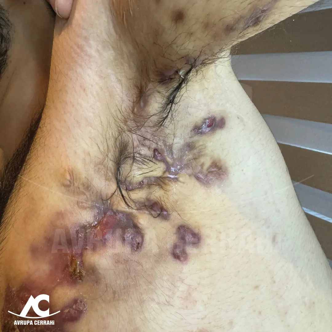 Hidradenitis Suppurativa