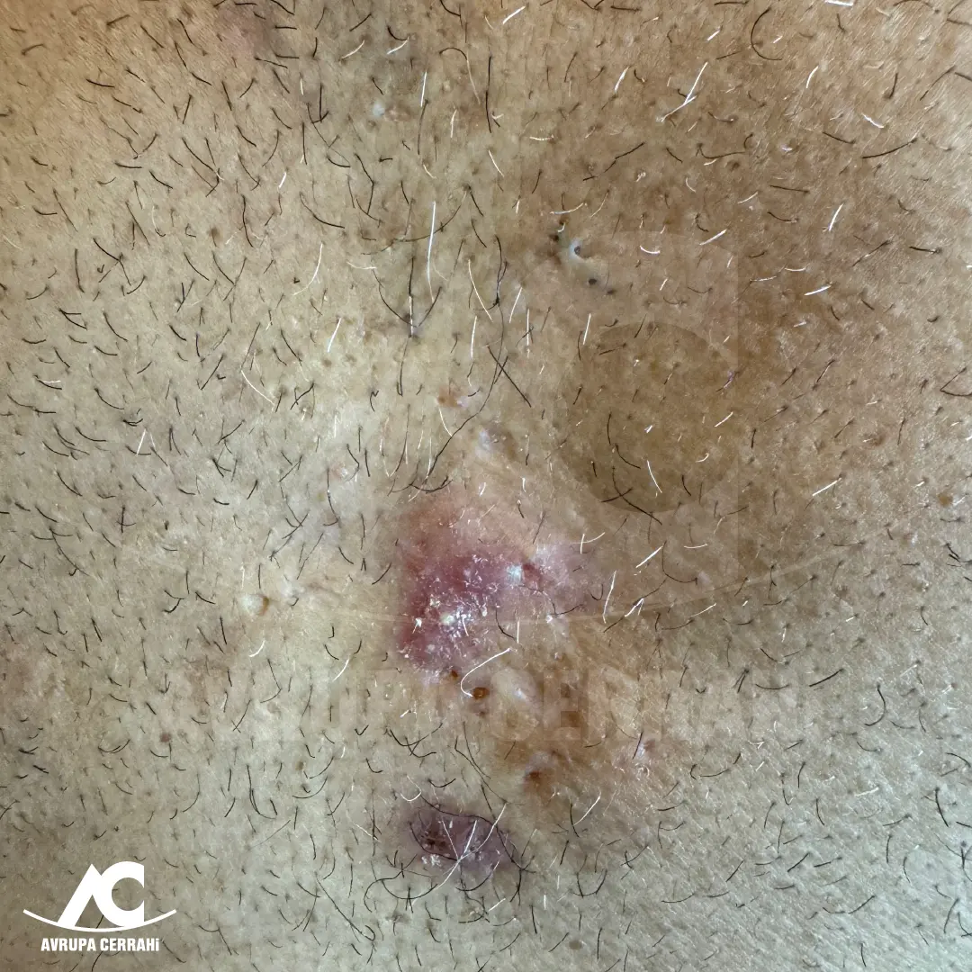 Hidradenitis Suppurativa