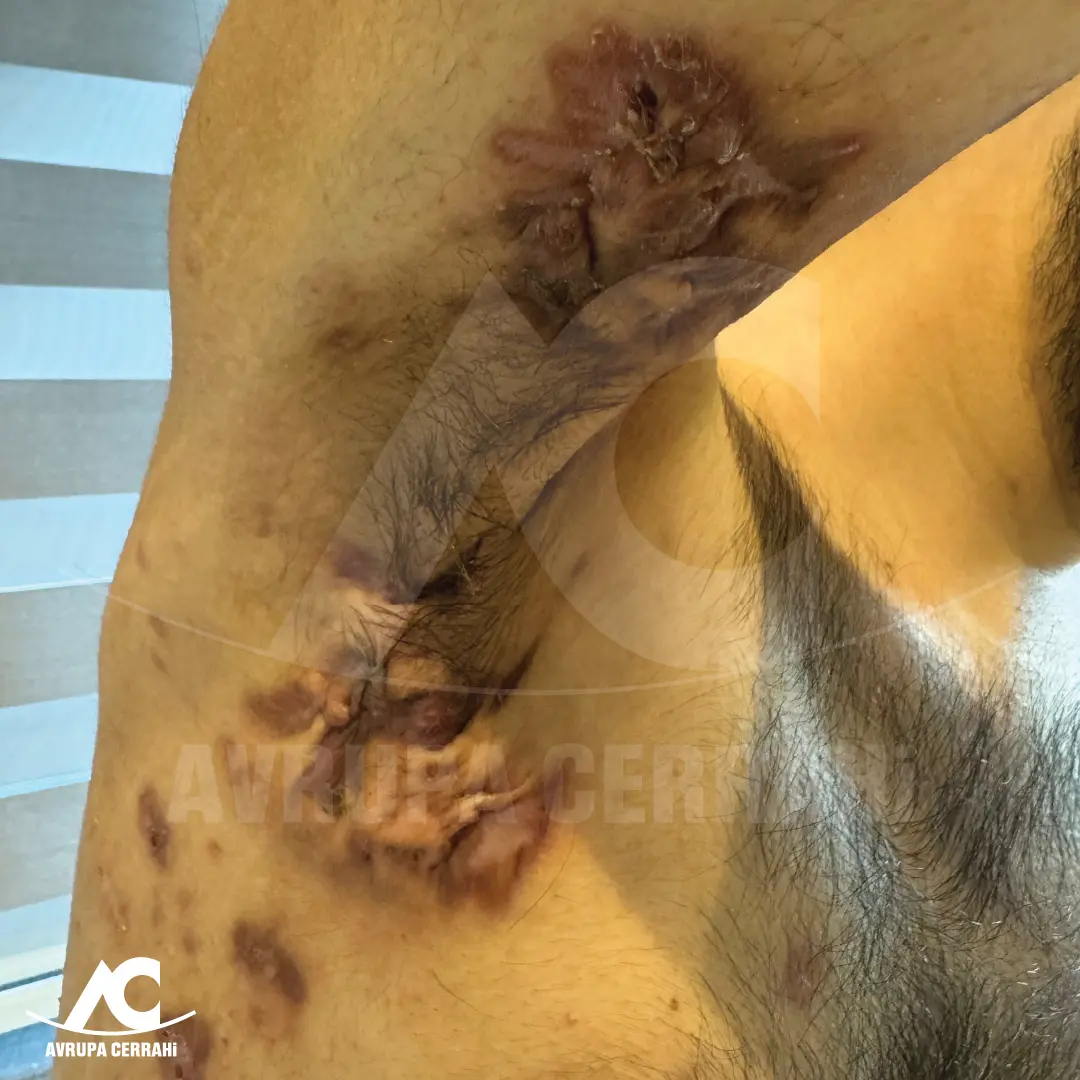 Hidradenitis Suppurativa