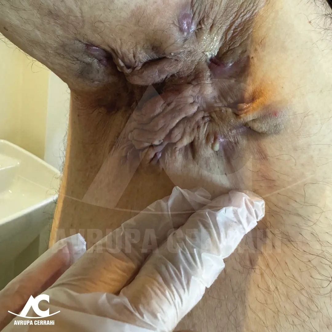 Hidradenitis Suppurativa