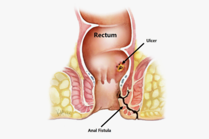 Quels sont les types de fistules anales ?