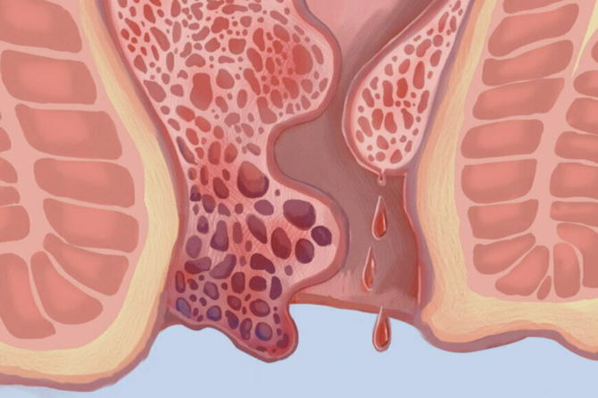 Traitement du Fissure Anale avec du Botox