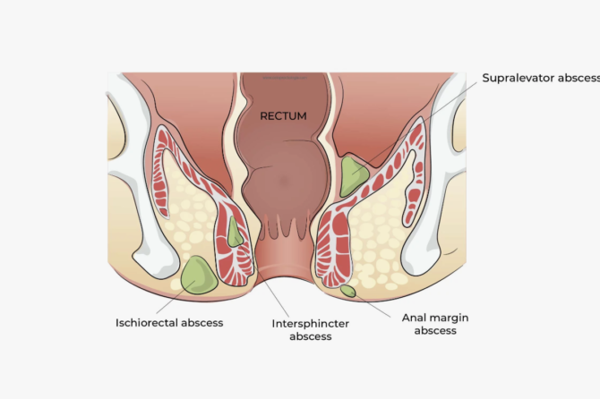 Comment se forme un abcès périanal ?