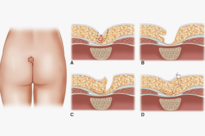 Pourquoi des Démangeaisons et de l’Acné apparaissent-elles au Niveau du Coccyx ?