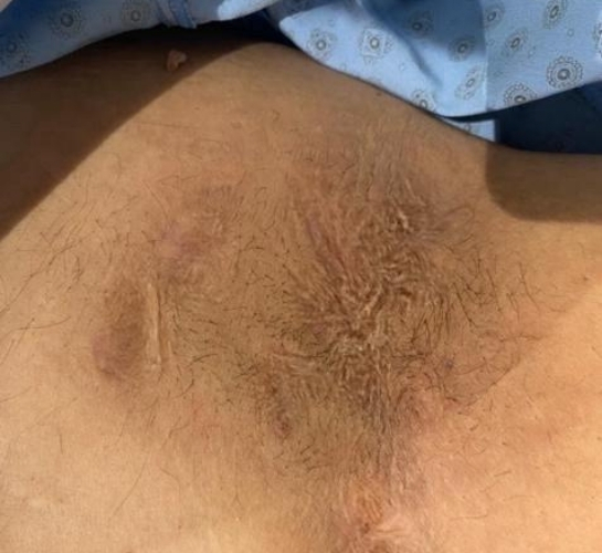 Hidradenitis Suppurativa după tratament