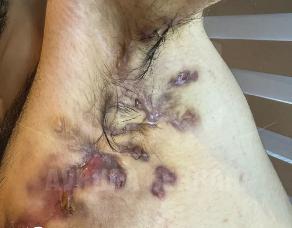 Hidradenitis Suppurativa