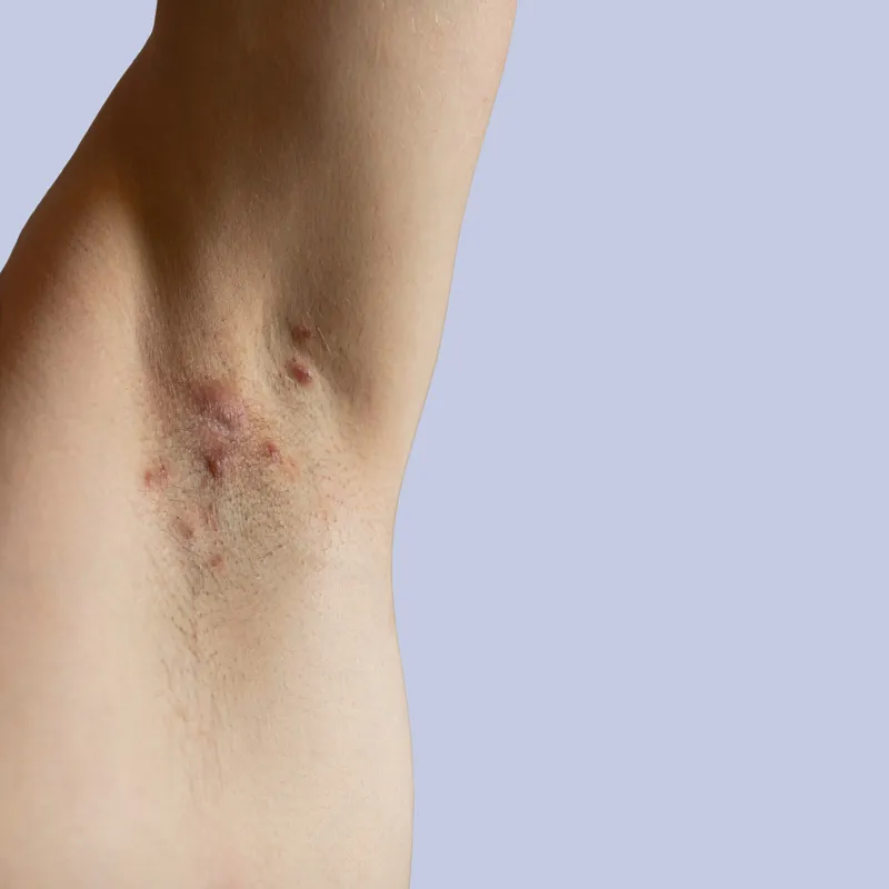 Hidradenitis Suppurativa