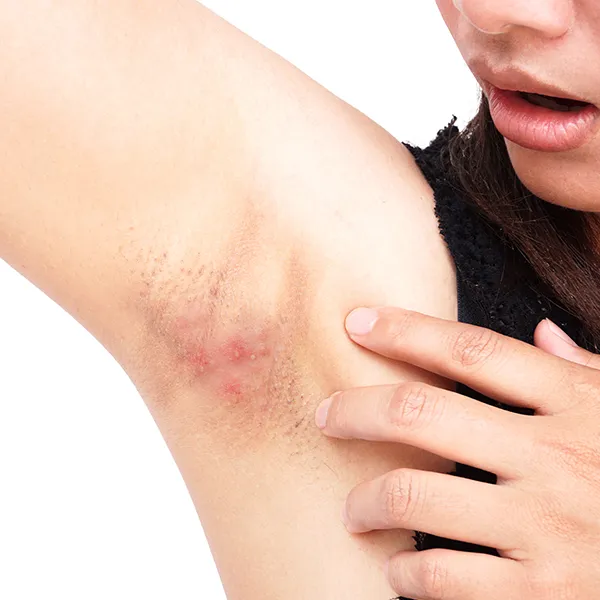 Hidradenitis Suppurativa